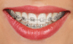 Clear Braces Milford, MA, Adult Orthodontics